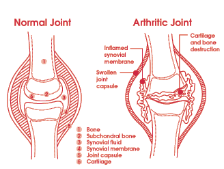 Diagram of Healthy Joint and Arthritic Joint