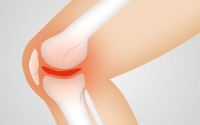 Collagen May Help Reduce The Pain Of Osteoarthritis